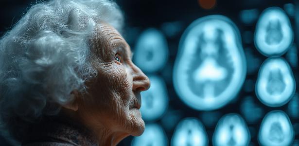 Cerca de 80% dos casos de Alzheimer no Brasil não são diagnosticados