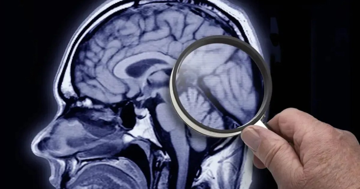 Estudo identifica proteína que acelera desenvolvimento do Alzheimer