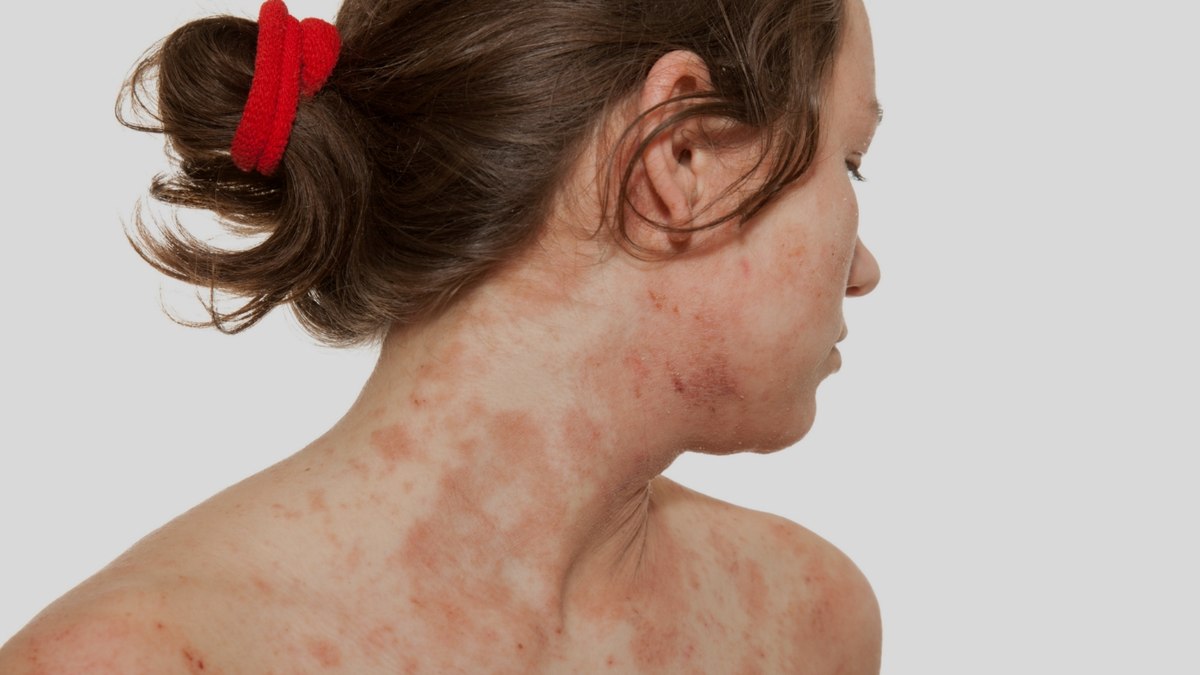 Dermatite atópica: 5 cuidados que ajudam a prevenir novas crises