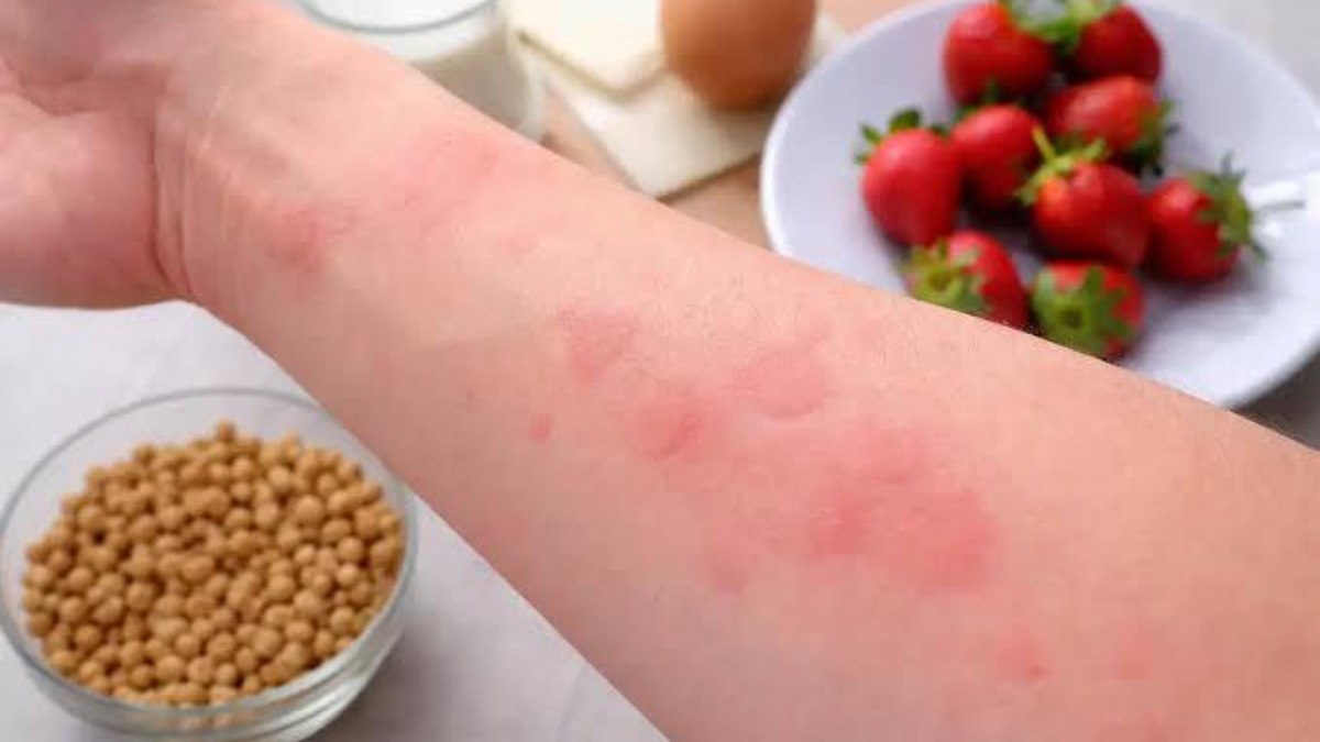 Alergia alimentar: veja sintomas, causas e quando procurar ajuda