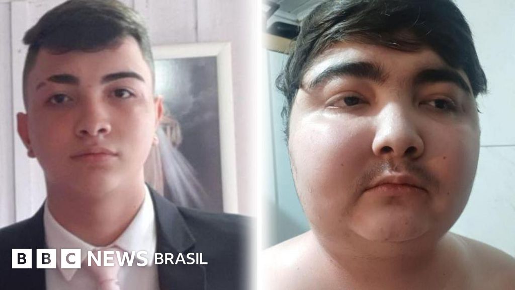 Tumor com menos de 1 centímetro fez adolescente ganhar 40 quilos em 6 meses