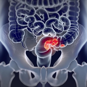 Câncer de intestino: 2 em cada 3 brasileiros não conhecem exame preventivo