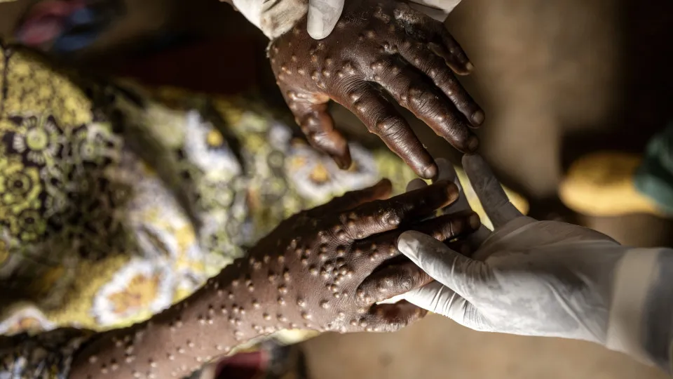 Guiné-Bissau confirma 1.º caso de mpox e apela à vigilância da população