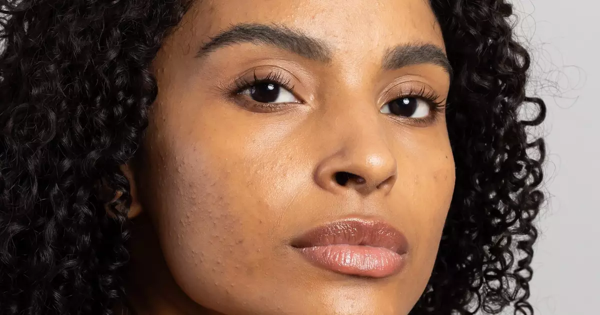 Mês de Conscientização da Acne incentiva cuidados especiais