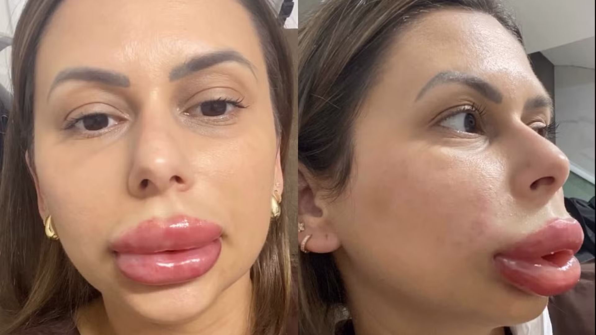 Confeiteira viraliza após ter inchaço labial fora do comum após procedimento: 'Ficaram preocupados, mas riram da minha cara'