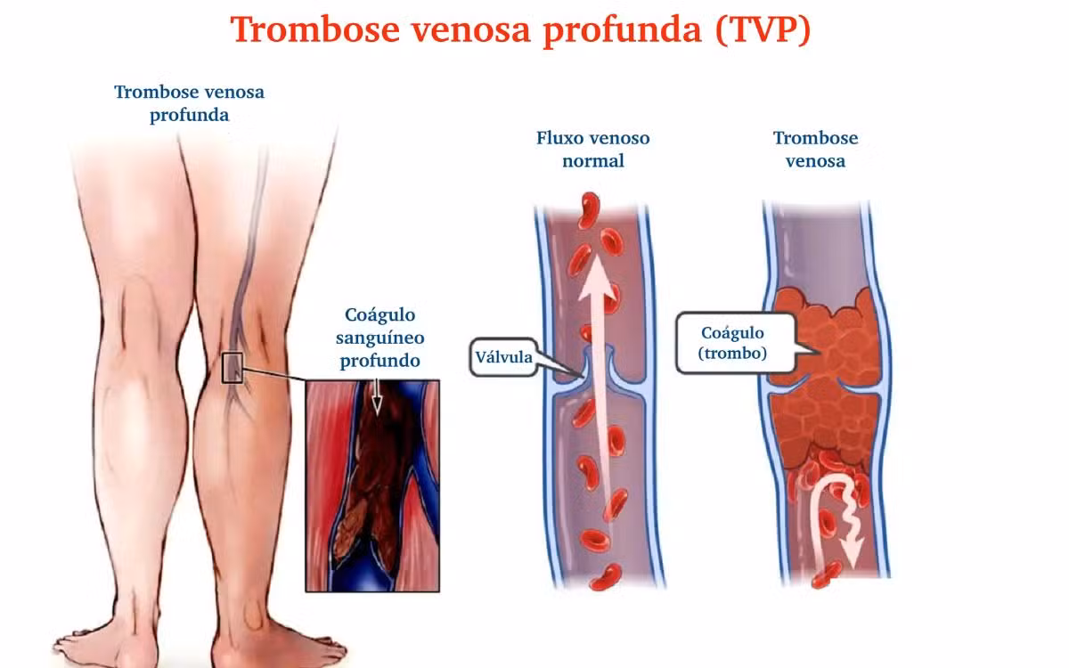 Trombose venosa: a complicação mais temida das varizes