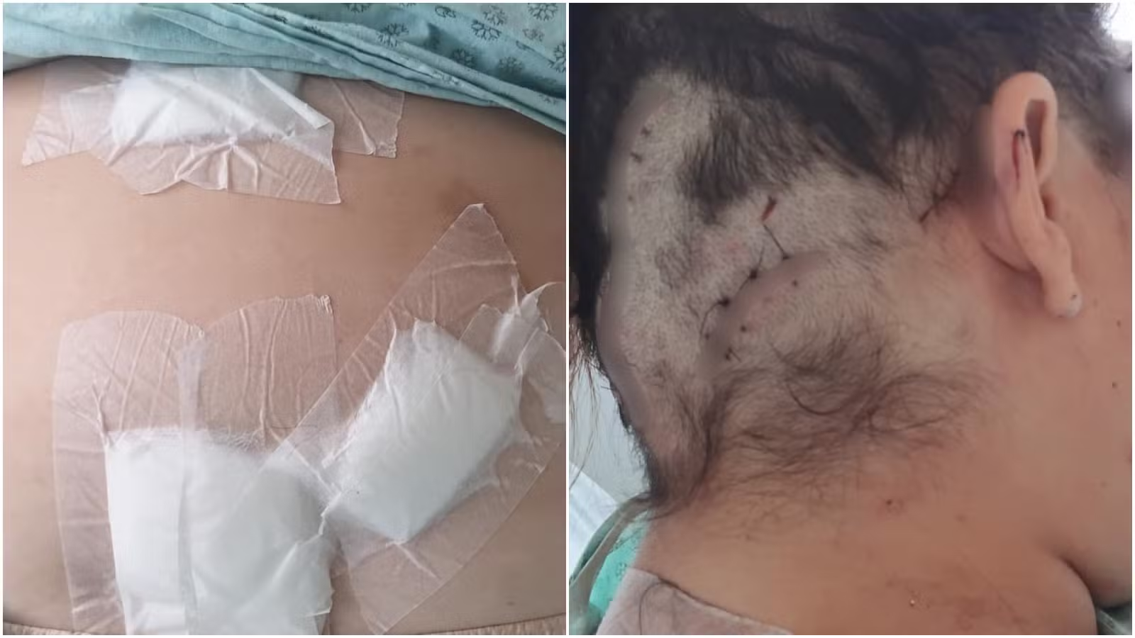 Mulher atingida pelo companheiro com 12 facadas só foi resgatada no dia seguinte às agressões: 'pedi ajuda para chamar uma ambulância'