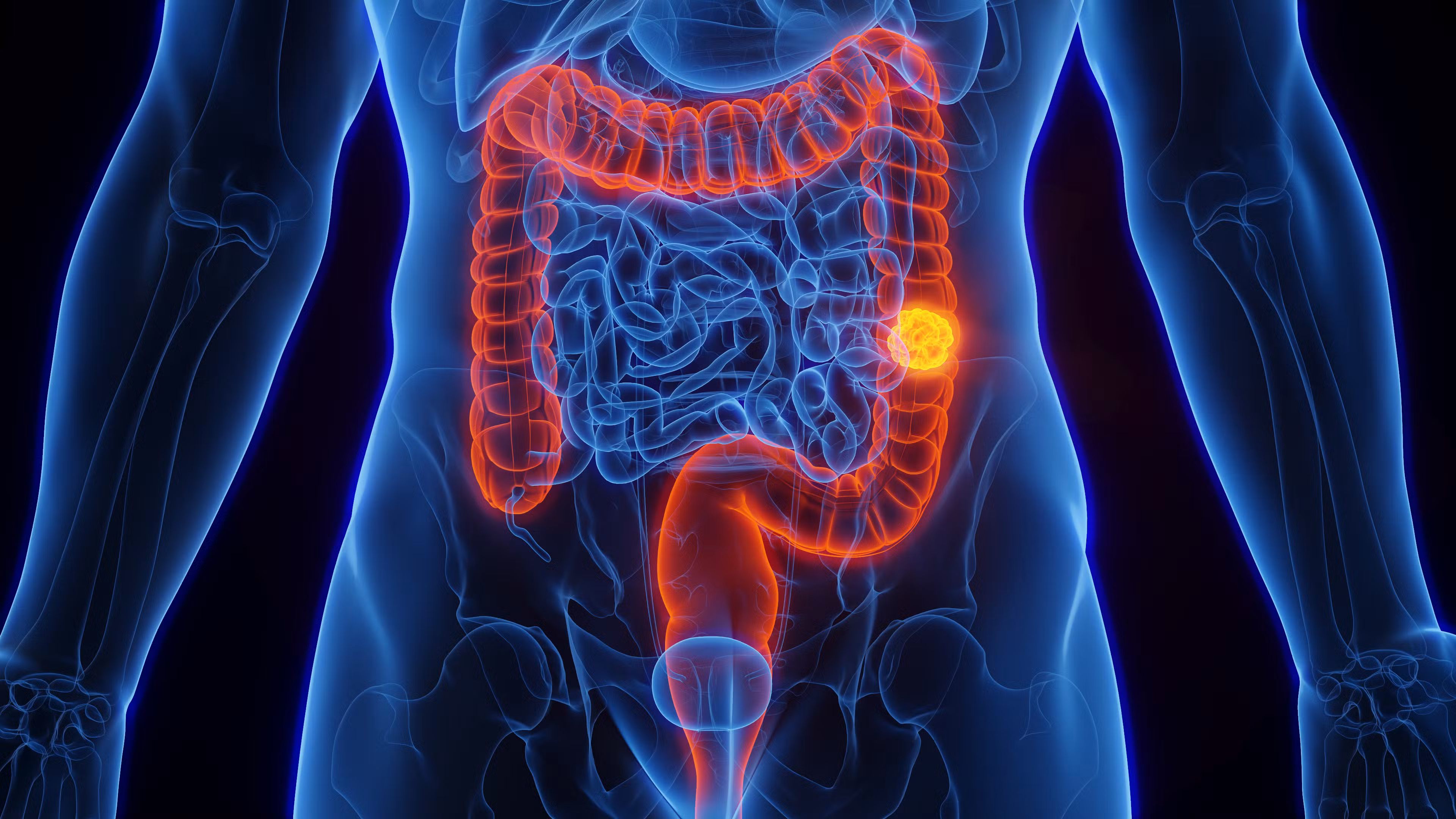 Quase 70% dos brasileiros não conhecem exame que pode identificar câncer de intestino; saiba os fatores de risco