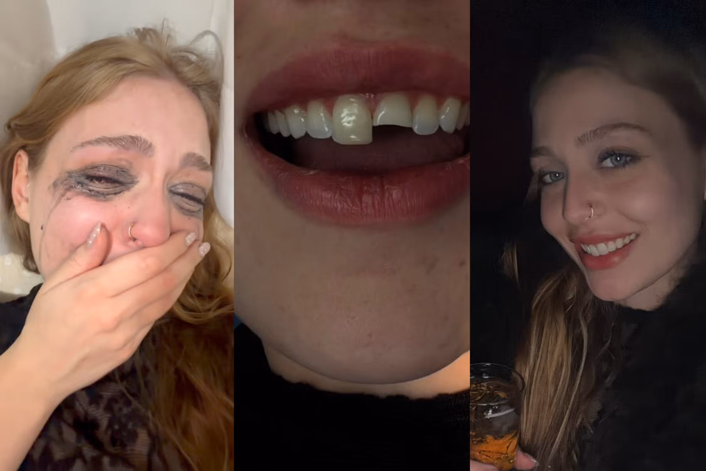 VÍDEO: jovem quebra dente na balada, procura dentista de madrugada e volta para a festa no PR