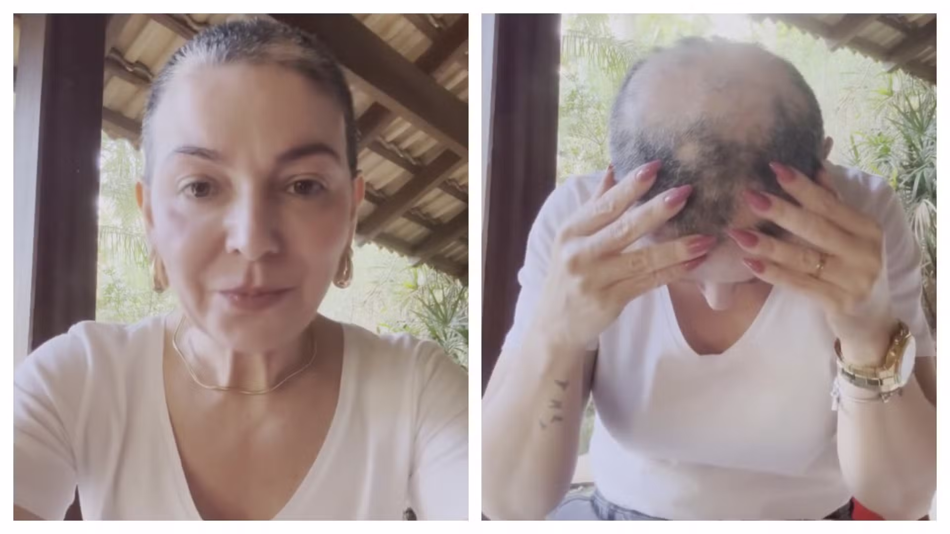 Mãe de Lucas Lucco revela volta de alopecia areata e desabafa nas redes: 'Vou seguir firme'