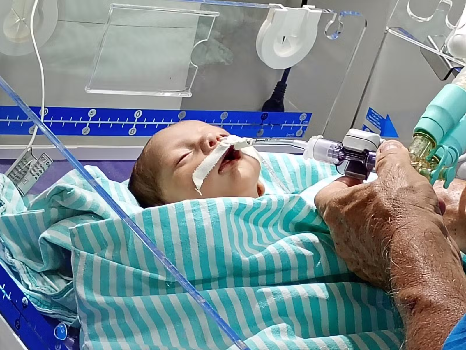 Bebê com malformação no coração tem piora e segue à espera de transferência no Acre