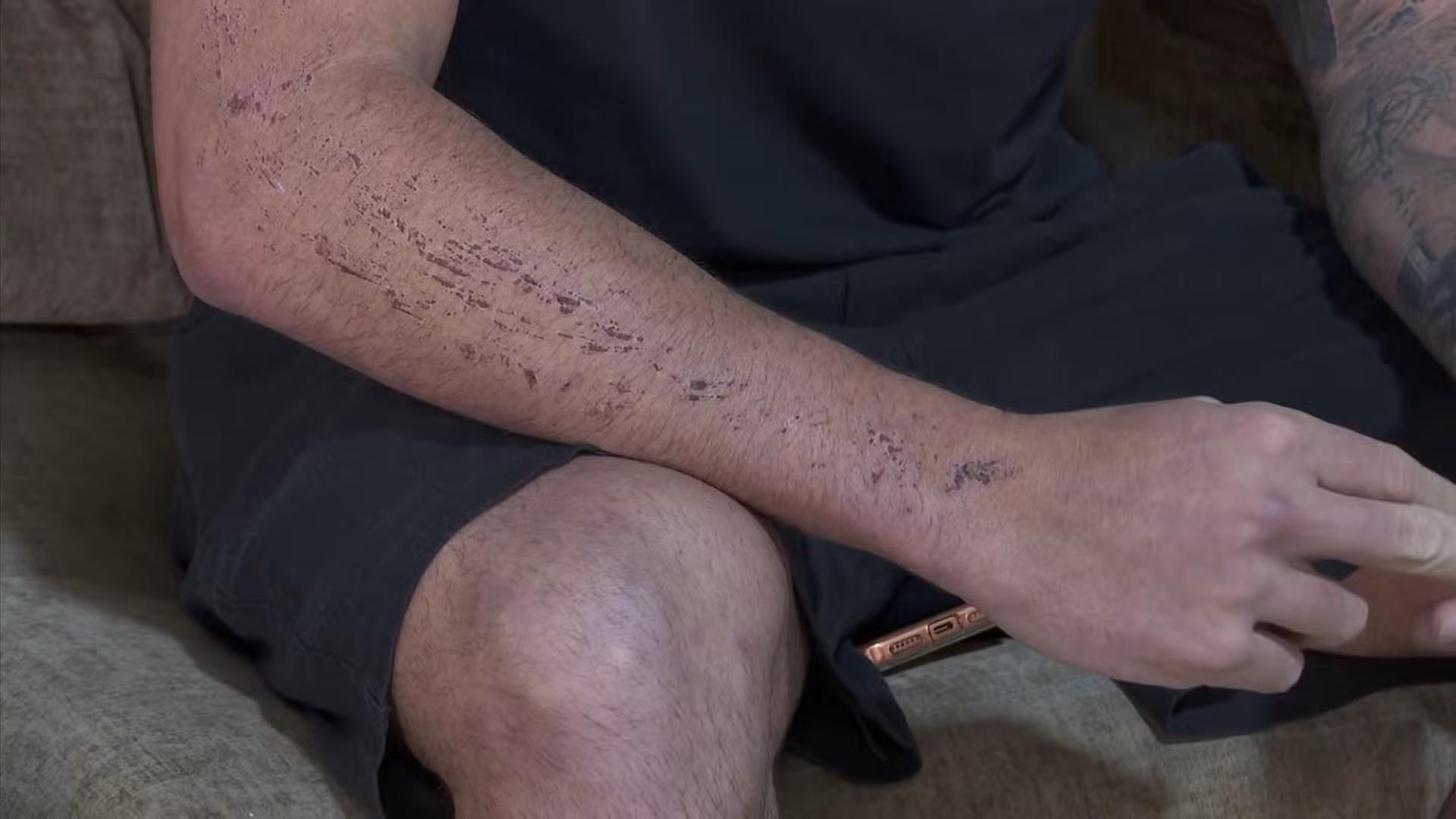 Jovem tem perna amputada após acidente com motorista alcoolizado em despedida de solteiro em Limeira
